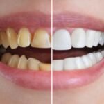 Common Cosmetic Dental Procedures And Their Long Term Benefits