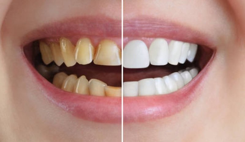 Common Cosmetic Dental Procedures And Their Long Term Benefits
