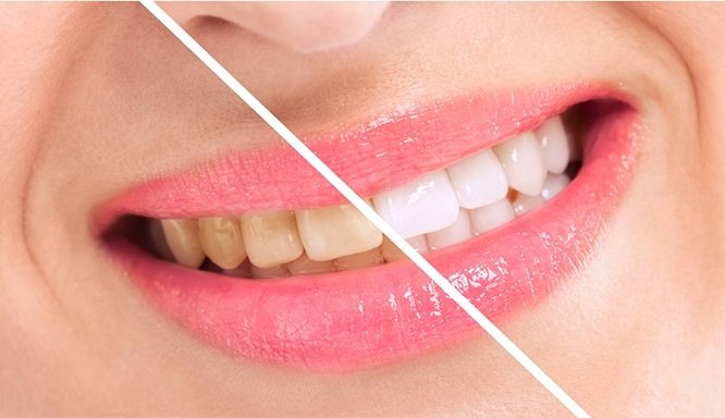 Teeth Whitening, Veneers, And More: Cosmetic Options Backed By General Care