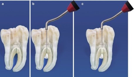 Advancements In Bioceramic Materials For Endodontic Therapy