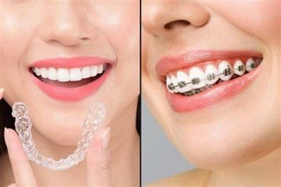 Clear Aligners Vs Braces: What Multi Age Families Should Consider