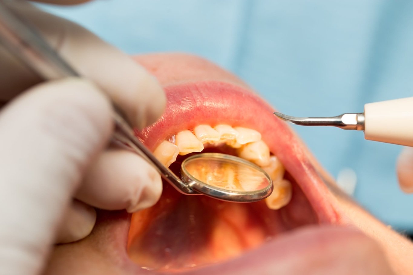 Why General Dentistry Plays An Important Role In Early Disease Detection
