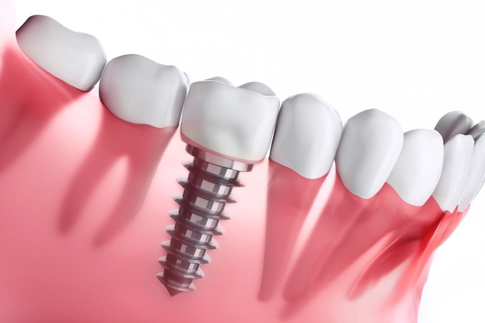 Why Implants Are Considered The Gold Standard For Tooth Replacement