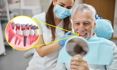 6 Tips For Maintaining Long Term Implant Success