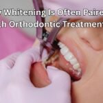 Why Whitening Is Often Paired With Orthodontic Treatment